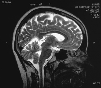 МРТ Головного мозга